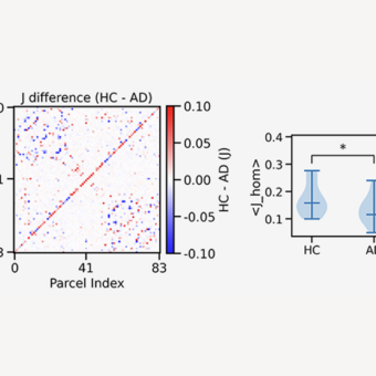 Brain Dynamics in Alzheimer’s Disease: Insights from Computational Spin-Glass Models