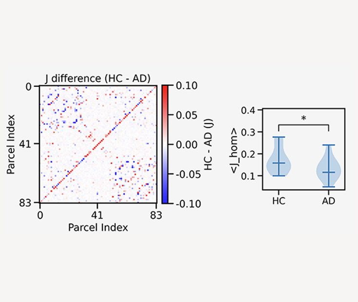 Brain Dynamics in Alzheimer’s Disease: Insights from Computational Spin-Glass Models